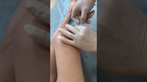 Укол Ферматрон плюс в коленный сустав