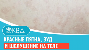 ? Красные пятна, зуд и шелушение на теле. Клинический случай №734