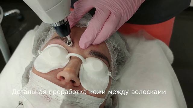 Лазерное удаление татуажа на аппарате Capello Multy в Центер косметологии "Галамед" смотреть онлайн