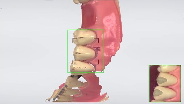 3Shape TRIOS - Scanning for surgical guide - Single implant case смотреть онлайн