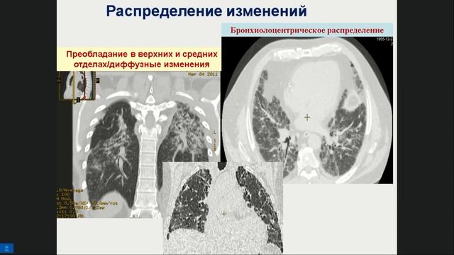Трушенко Н.В. Гиперчувствительный пневмонит смотреть онлайн