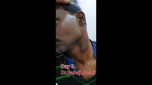Scrofuloderma | Tubercular Infection | Treated | Dr.Sahaj Joshi смотреть онлайн