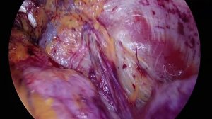 eTEP-пластика двусторонних прямых паховых грыж