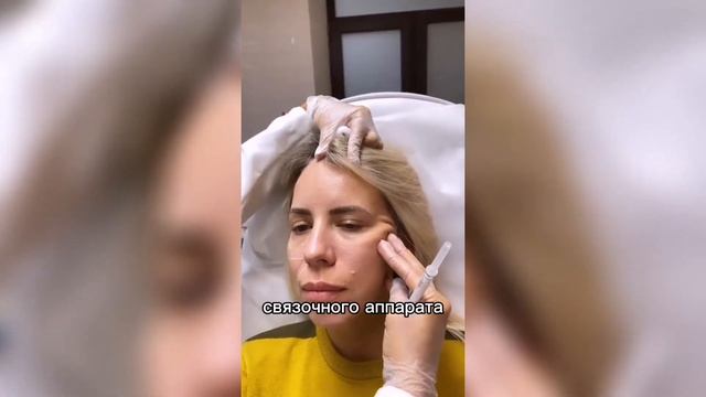 Radiesse. Подтяжка лица. убираем носогубные складки. смотреть онлайн