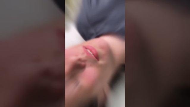 Гиалуроновые Усы Филлер над губой что делать #губы #губымосква #ботокс #косметологмосква