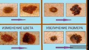 Опасные родинки или меланомы.. как их определить и ухаживать