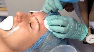 АирисКом обучение косметологии. Легкие филлеры - заполнение морщин в области лба