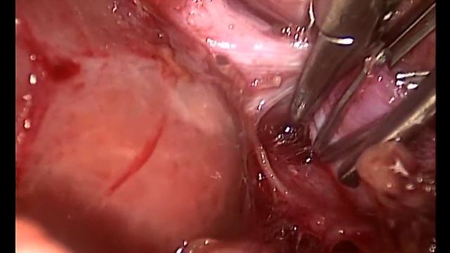 Сосудистая изоляция ВВ правая  доля печени