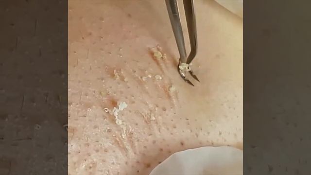 Удаление прыщей Черноголовых| Needle Tweezers Blackhead Pimples Removal Pointed | Face Care Tools C