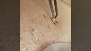 Удаление прыщей Черноголовых| Needle Tweezers Blackhead Pimples Removal Pointed | Face Care Tools C