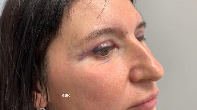 Блефаропластика ОТЗЫВЫ до и после у Доктор Романов Игорь пластический хирург