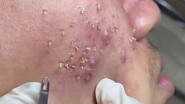 Удаление черных точек 2022 EP03