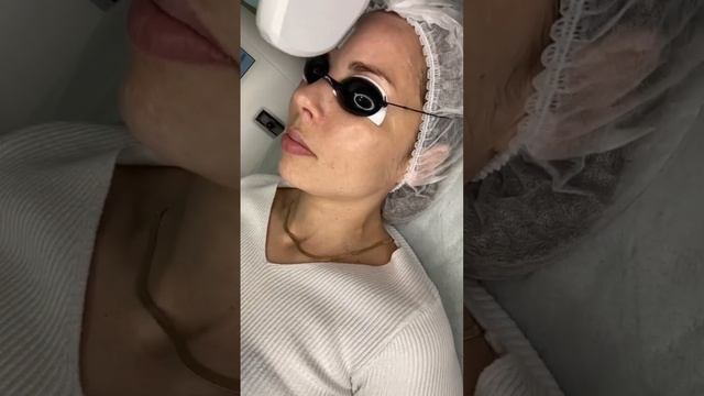 Фотоомоложение - процедура с эффектом «фарфоровой кожи». Осветление пигментации, сияние кожи смотреть онлайн