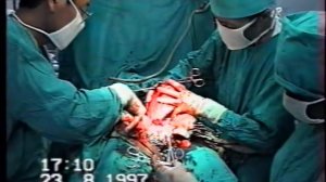 Кесарево сечение №12+Ампутация матки