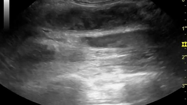 Тромбоз брюшной аорты у собаки на УЗИ смотреть онлайн