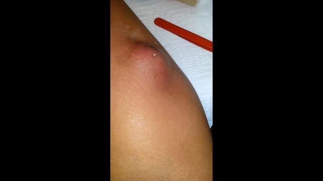 БОЛЬШОЙ ЧИРЕЙ/БОЛЬШОЙ ЧИРЯК/БОЛЬШОЙ ПРЫЩ/БОЛЬШОЙ ГНОЙНИК смотреть онлайн