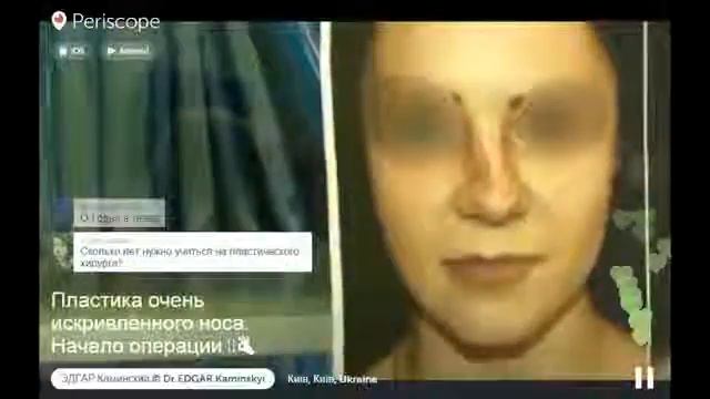 Dr Edgar Пластика искривленного носа Перископ Трансляция смотреть онлайн