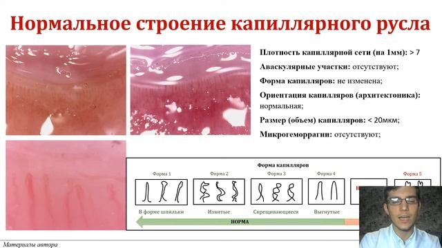 Капилляроскопия. СНК факультетской терапии им. акад. А.И. Нестерова РНИМУ
