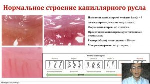 Капилляроскопия. СНК факультетской терапии им. акад. А.И. Нестерова РНИМУ