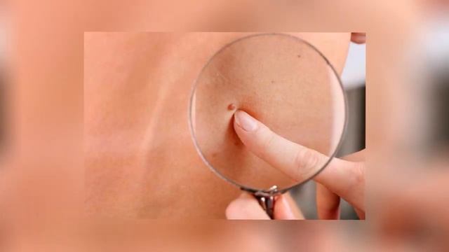 ПОЧЕМУ НА РОДИНКЕ РАСТУТ ВОЛОСЫ? смотреть онлайн