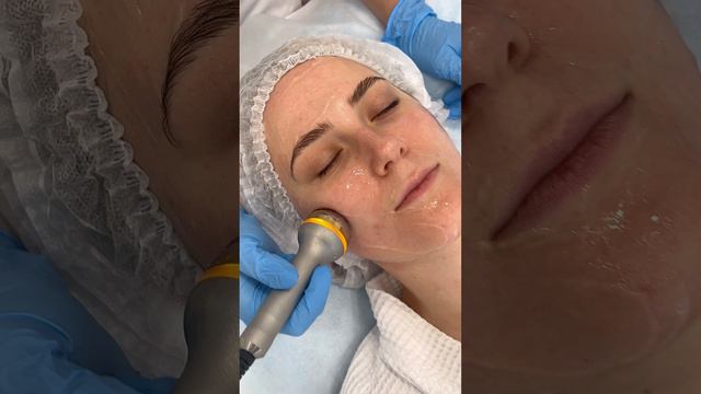 Омоложение SKINOVA PRO - как проходит процедур в клинике GEN87 смотреть онлайн