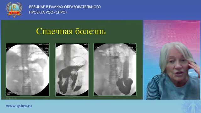 Острая кишечная непроходимость. Рентгенодиагностика смотреть онлайн