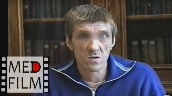 Шизофрения. Фабула величия. Парафренный синдром © Schizophrenia, paraphrenic syndrome