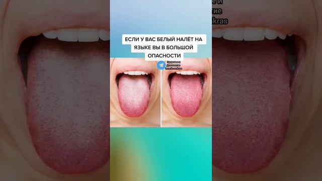 если у вас белый налёт на языке вы в большой опасности #народнаямедицина #зож #народныерецепты смотреть онлайн