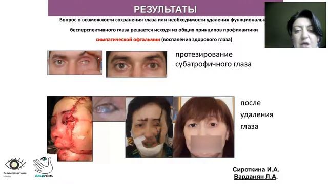 Опыт протезирования глаз тонкостенными протезами. Клинические примеры. Круглый стол ГП-2020. смотреть онлайн