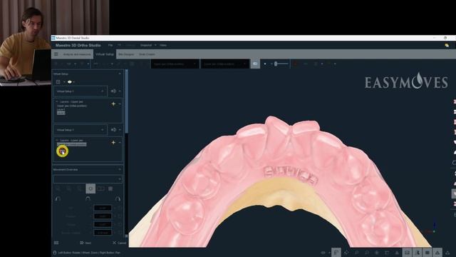 Maestro 3D Aligners Virtual Setup: Case 14, Molars' Upright