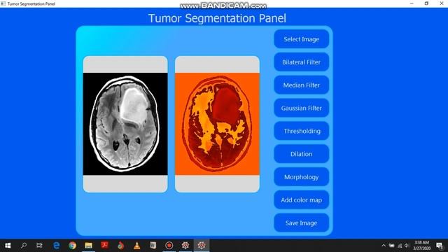 Brain tumor Segmentation using Python and openCV- PyQt GUI interface смотреть онлайн