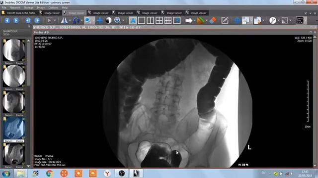 ИРРИГОСКОПИЯ  ИРРИГОГРАФИЯ  РЕНТГЕНОГРАФИЯ  делать или нет .
