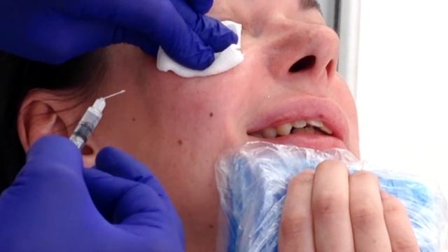 АирисКом: Студенты учатся. Применение филлеров в области глаз при МЕШКАХ И ОТЕКАХ под глазами. смотреть онлайн