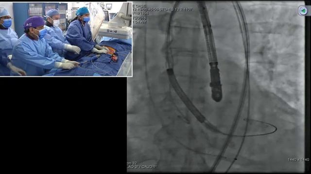 CoreValve Evolut-R TAVR (34mm) via Percutaneous Femoral Access Structural Heart Live - Dec 14, 2016 смотреть онлайн