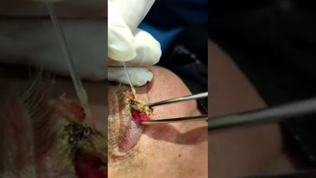 Удаление базалиомы в клинике Альфа - Мед смотреть онлайн