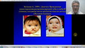 ВРОЖДЕННЫЕ ПОРОКИ  РАЗВИТИЯ ЛИЦА  РАСЩЕЛИНЫ ВЕРХНЕЙ ГУБЫ И НЕБА