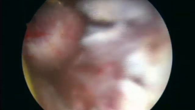 resezione transuretrale di vescica смотреть онлайн