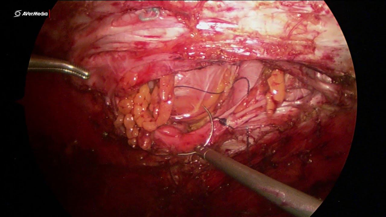 Laparoscopic Incisional Recurrent Hernia + Diastasis Correction ETEP+partial One Side TAR