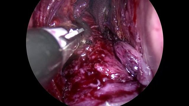 Vaginal Natural Orifice Transluminal Surgery (V-NOTES) смотреть онлайн