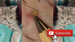 粉刺 粟粒腫 Самое залипательное видео давить прыщи Черные точки Dermatologist video to press pimples