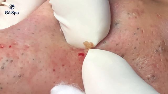 Super Blackheads Part 4 | Ga Spa| 11.02.2022 смотреть онлайн