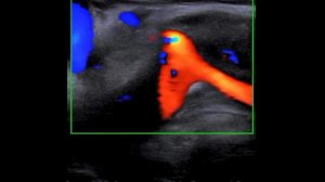 Диссекция брахиоцефального ствола и общей сонной артерии