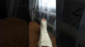 Перелом лодыжки