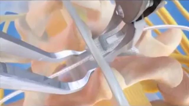 Установка динамического межостистого импланта DIAM смотреть онлайн