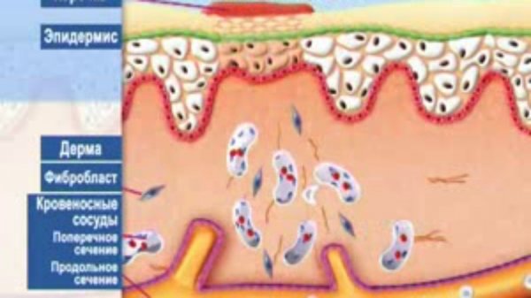 Лечение ран с помощью светотерапии Биоптрон.