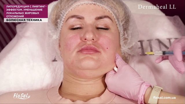 Уменьшение локальных жировых отложений — коррекция объемов нижней трети лица. Dermaheal LL