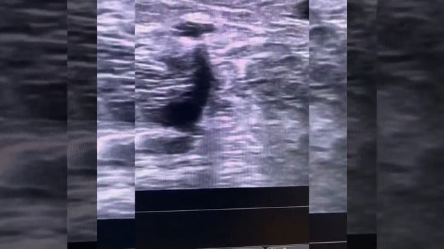 Перфорантная вена Кокетта. Флеболог Алексей Скринник смотреть онлайн