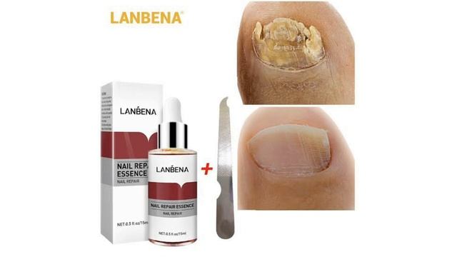 মাত্র ৫দিনে হাত ও পায়ের নখের ফাঙ্গাস দূর করে | lanbena nail repair essence serum review смотреть онлайн