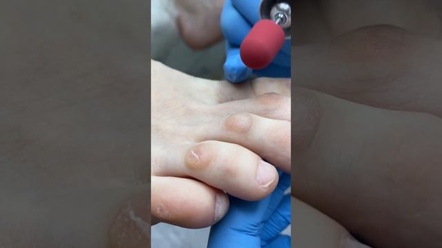 Как убрать мягкую мозоль смотреть онлайн