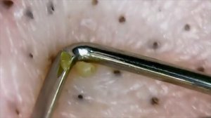 Удаление и выдавливание черных точек и прыщей под микроскопом